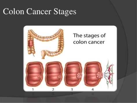 colon-cancer-stagestypes-2-638